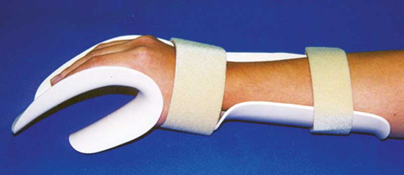 Splints Displayu Splinting and occupational therapy